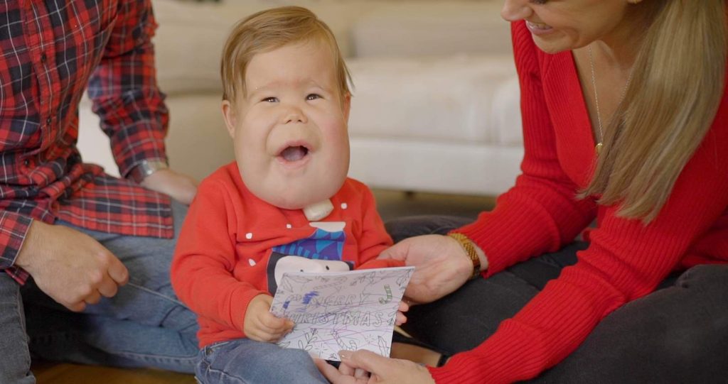 A young boy with a Lymphangiomas on his face, is sat with his parents on the floor. He is wearing a red Christmas jumper featuring a penguin on the front.